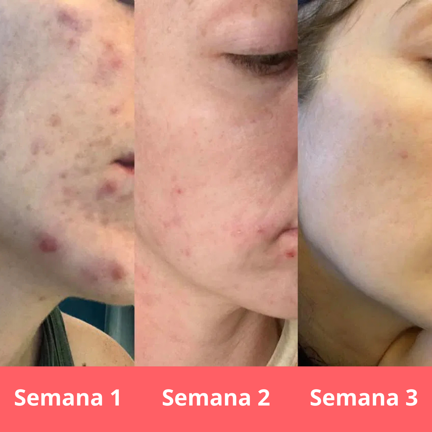 Sérum anti acné y rojeces de centella asiática | 100ml
