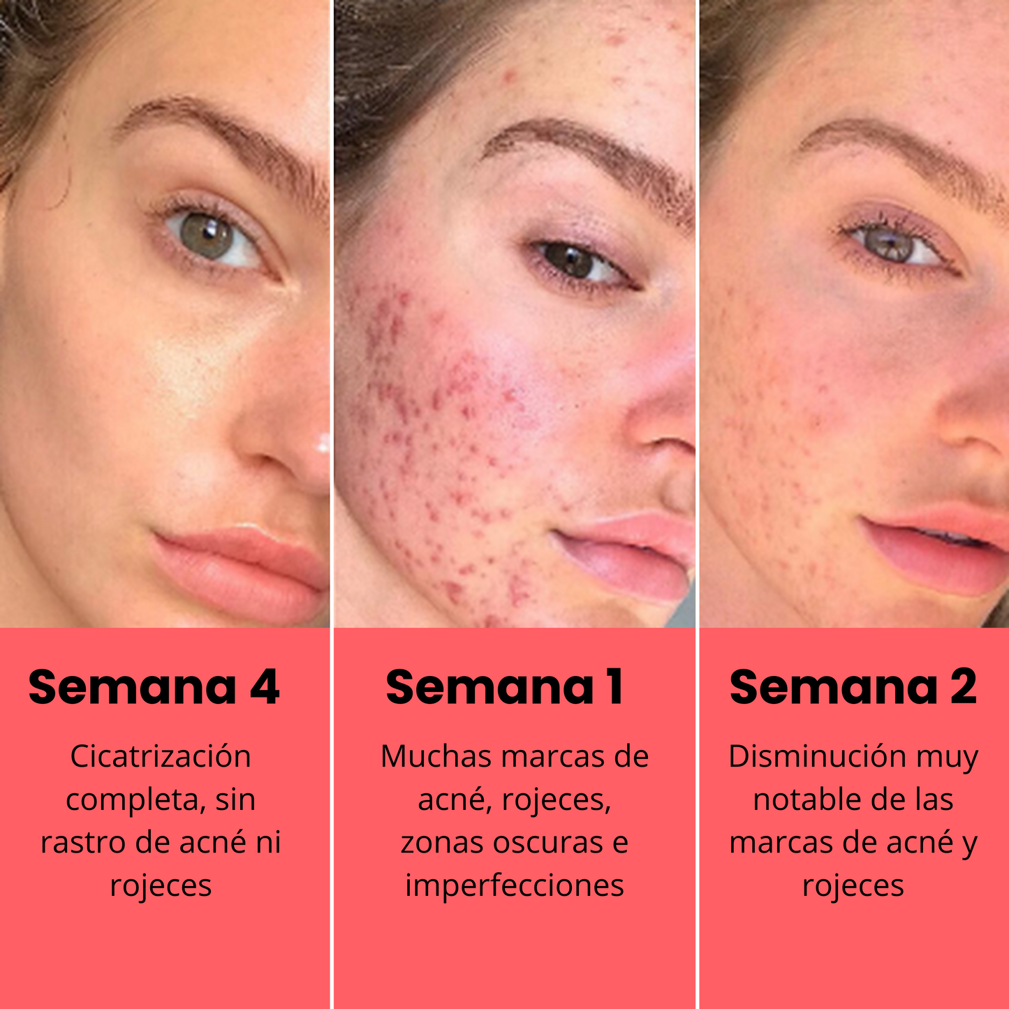 Crema anti acné y rojeces 345 | 50ml